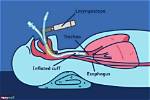 Can Nurses Do Extubation?