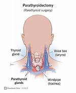 Can Parathyroidectomy Cause Thyroid Problems?