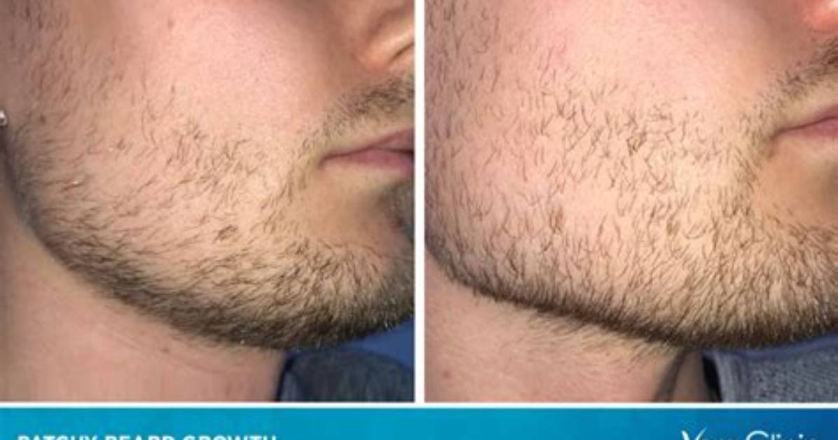 Can Patchy Beard Be Fixed?