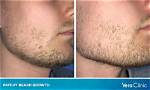 Can Patchy Beard Be Fixed?