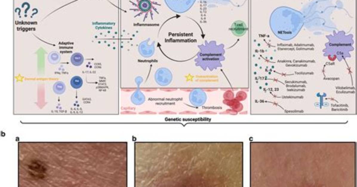 Can Pyoderma Be Cured