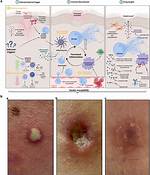 Can Pyoderma Be Cured