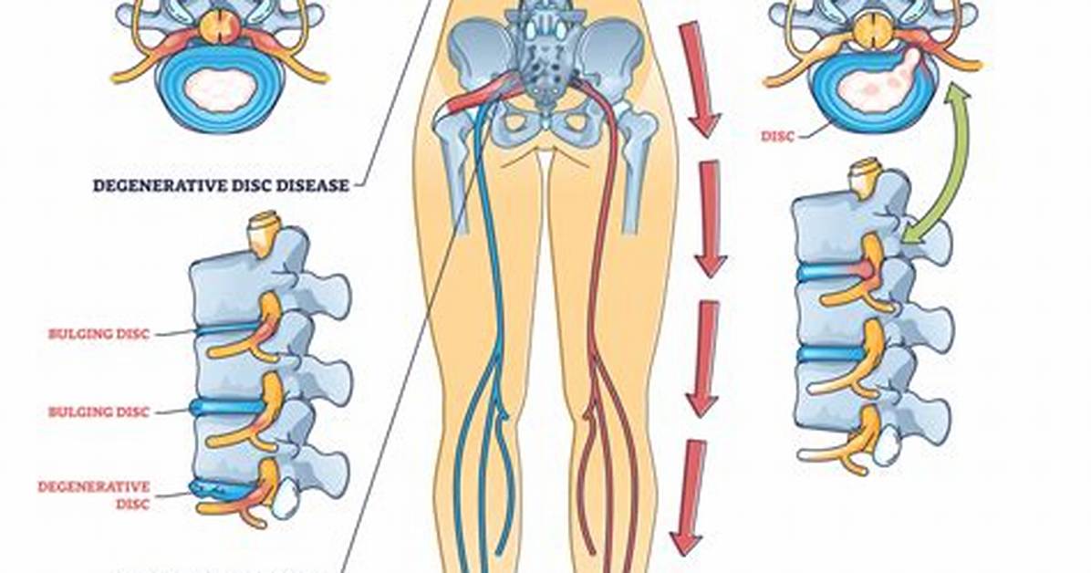 Can Sciatica Affect Your Ovaries?