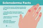 Can Scleroderma Kill You?