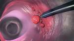 Can Sigmoidoscopy Remove Polyps?