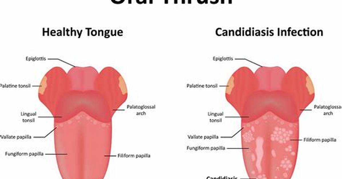 Can Thrush Be an Std
