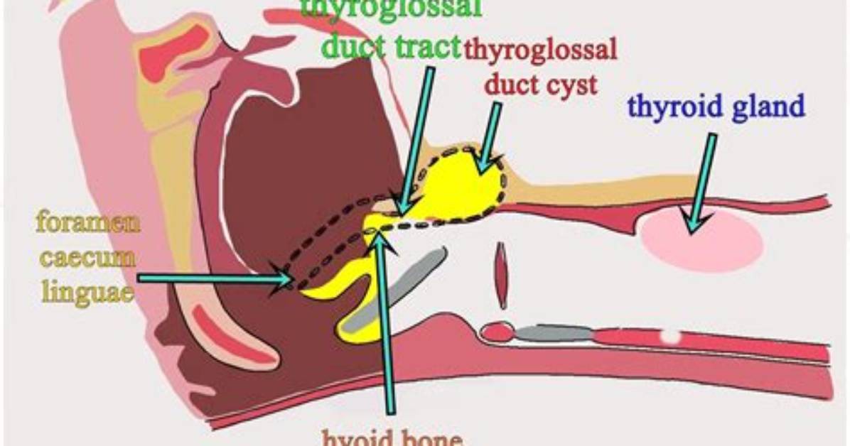 Can Thyroglossal Cyst Affect Thyroid Function?