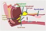 Can Thyroglossal Cyst Affect Thyroid Function?
