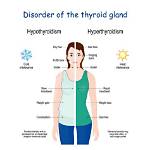 Can Thyroid Problems Cause Mental Issues