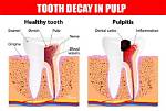 Can Tooth Pulp Fall Out