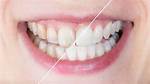 Can Transparent Teeth Be Fixed?