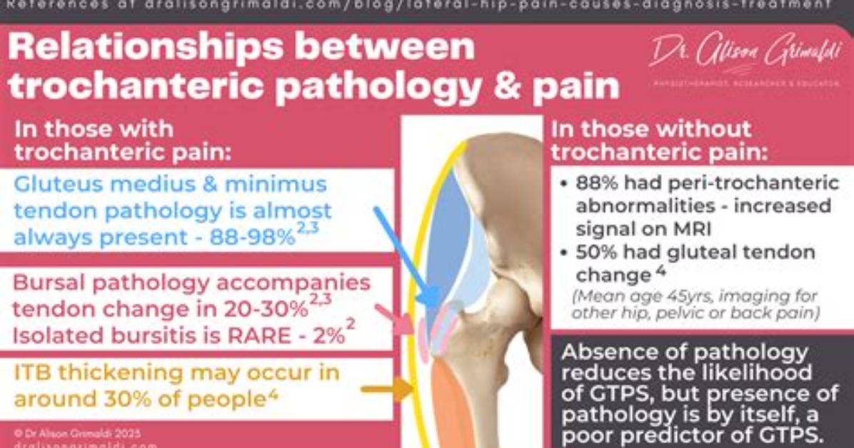 Can Trochanteric Bursitis Cause Sciatica?