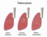 Can Tuberculosis Kill You?