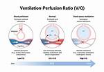 Can Ventilation Affect Perfusion?