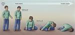 Can You Develop Cataplexy?