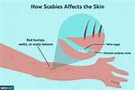 Can You Get Scabies from Sharing a Washing Machine?