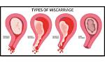Can You Unknowingly Miscarriage?
