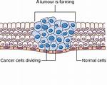 Cancer Cells from a Tapeworm Form Tumors in Patient with Hiv