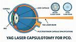 Capsulotomy - All About Vision