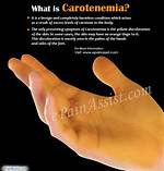 Carotonemia