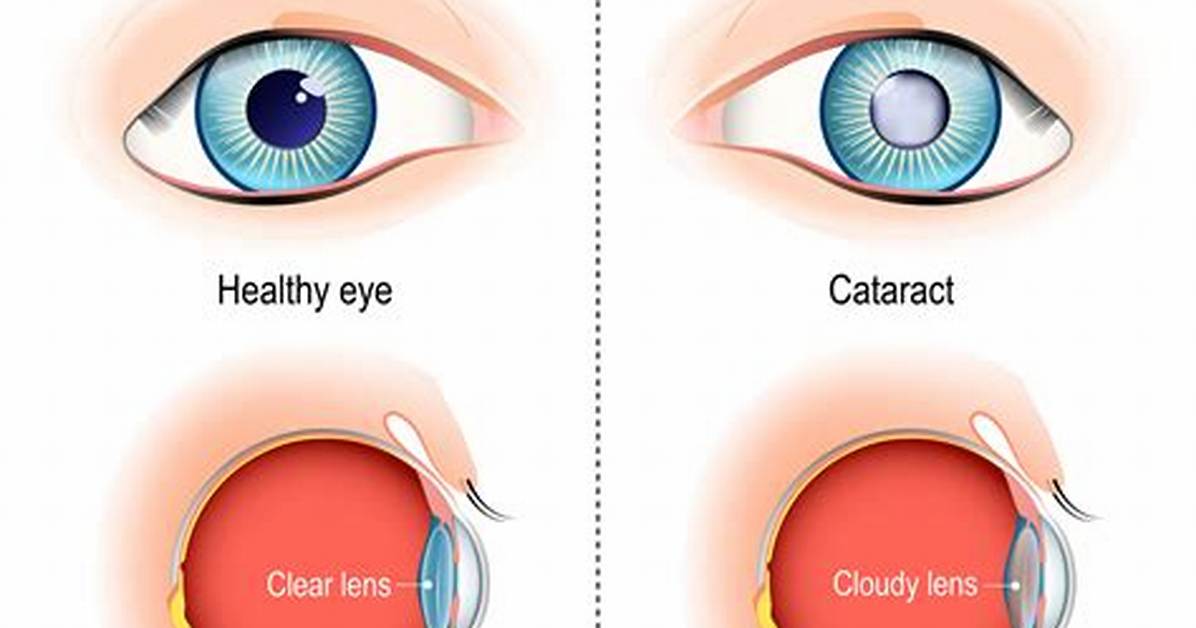 Cataracts