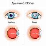 Cataracts