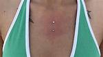 Chest Dermals