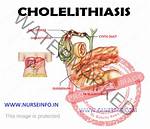 Choledocholithiasis Icd 10