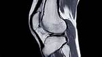 Chondrosis Knee