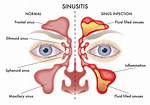 Chronic Pansinusitis