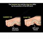 Claw Toe | Hammer Toe