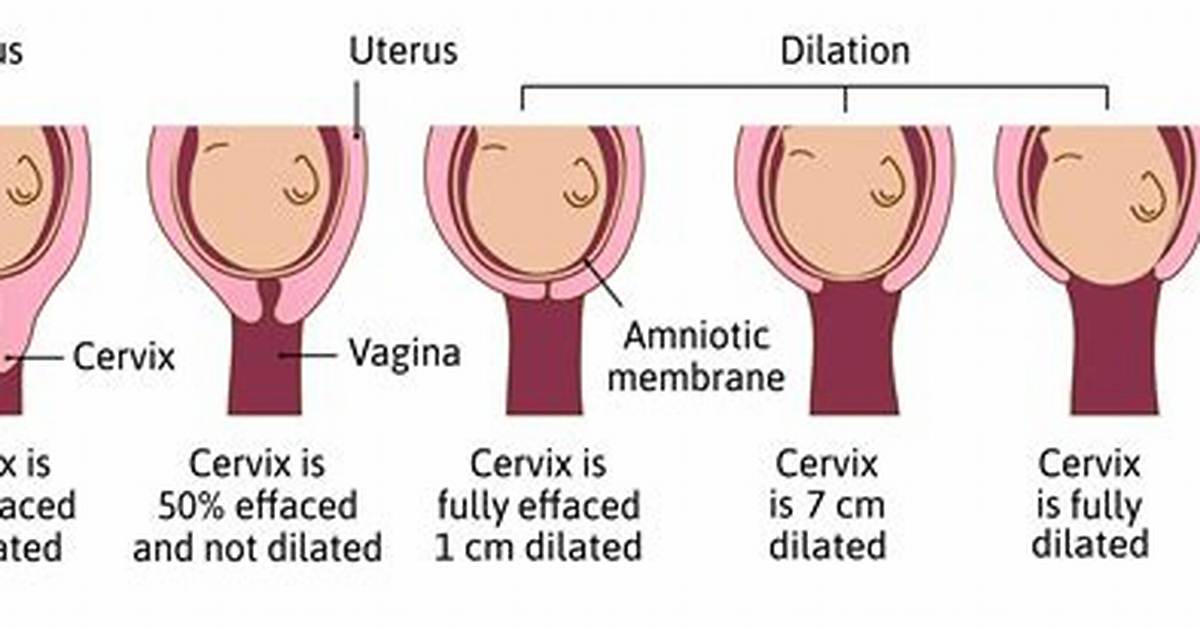 Cm Dilated