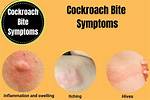Cockroach Bite Marks