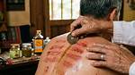 Coining Therapy