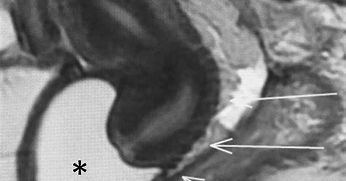 Colpectomy