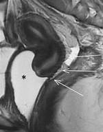 Colpectomy