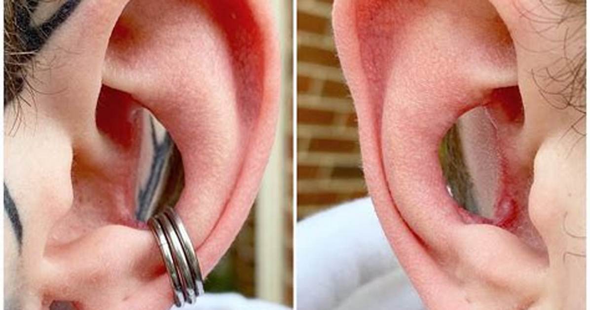 Conch Removal