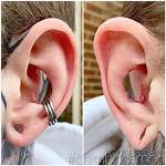 Conch Removal