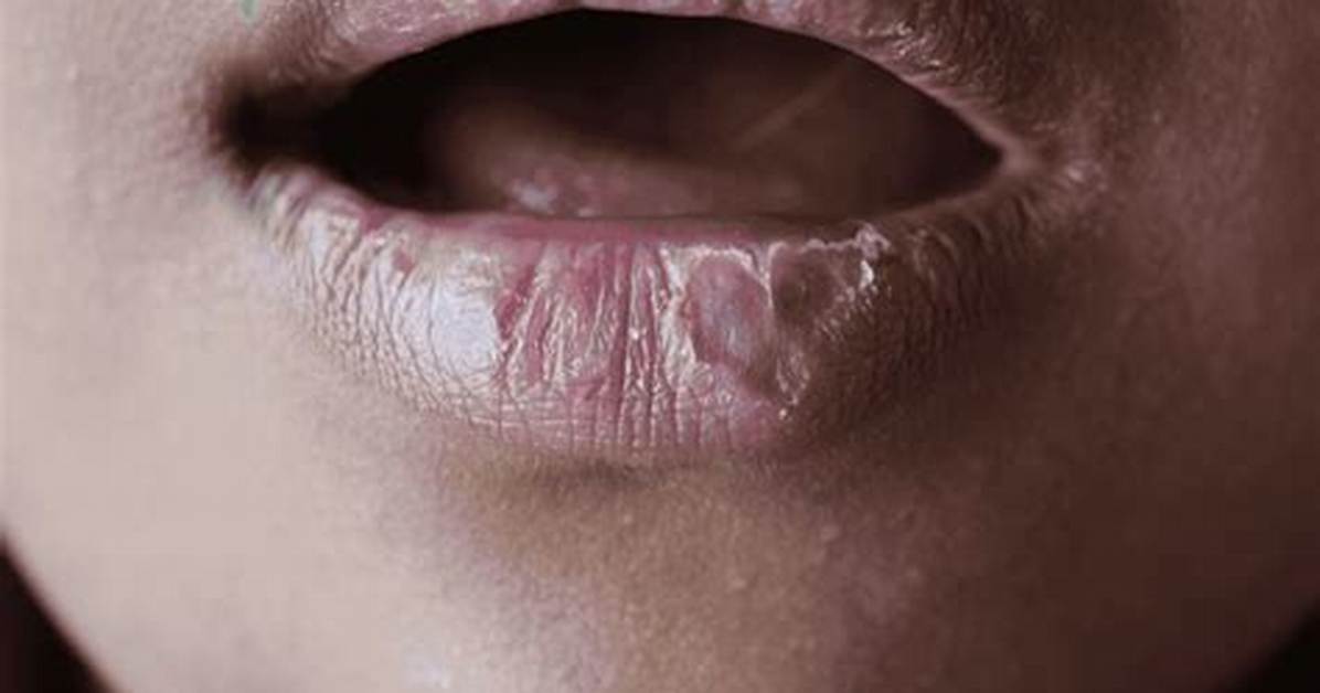Could Chapped Lips Be Something Else?