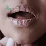 Could Chapped Lips Be Something Else?