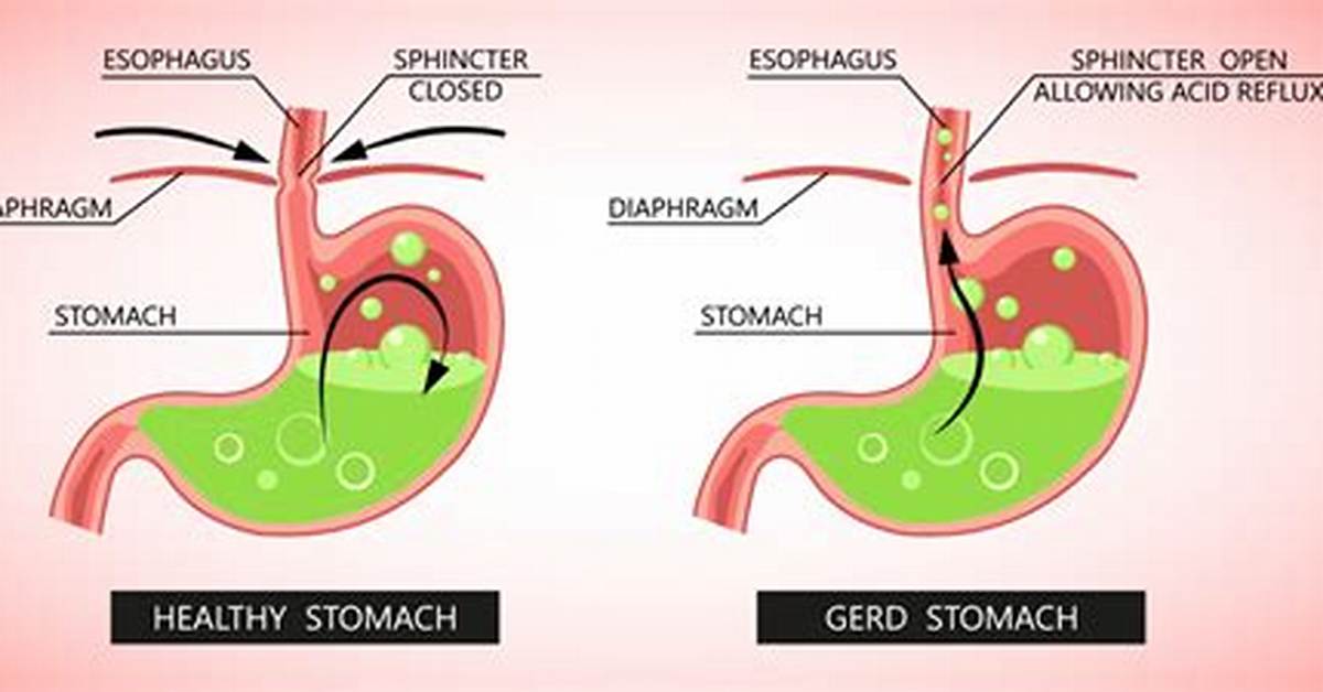 Could It Be Gerd?