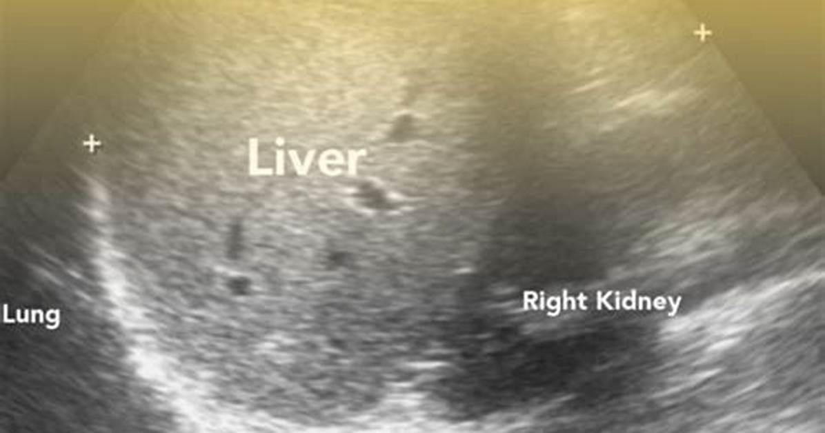 Could My Sonogram Be Wrong?