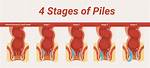 Could Piles Cause Bleeding?