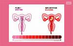 Could Plan B Cause Bleeding?