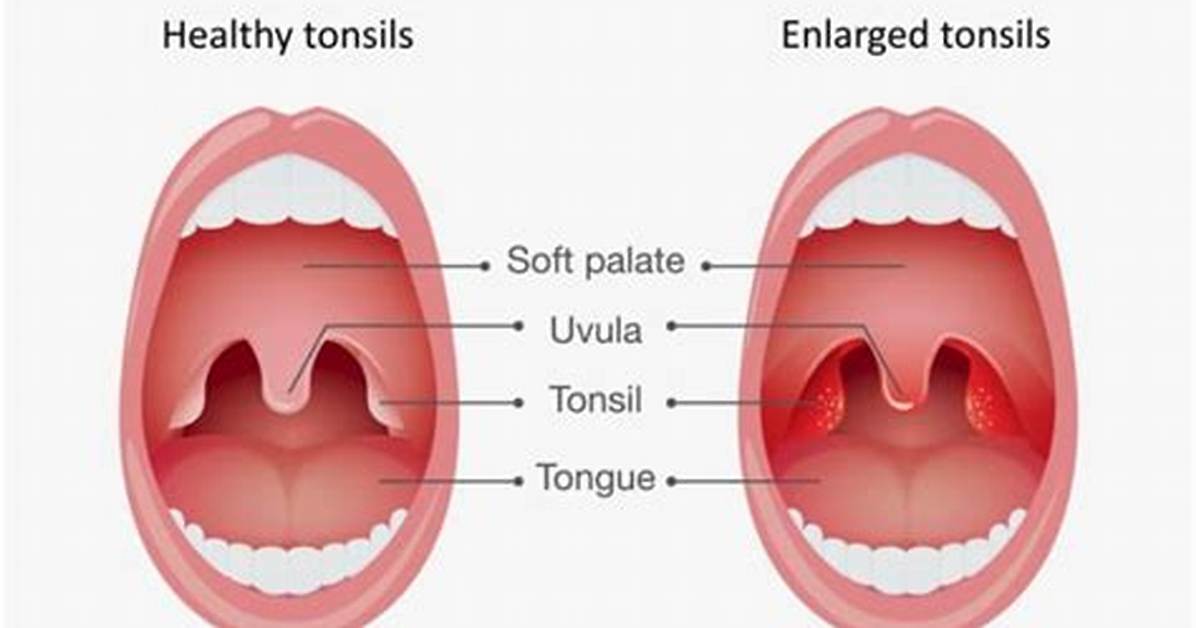 Could Tonsils Cause Snoring?