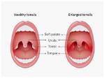 Could Tonsils Cause Snoring?