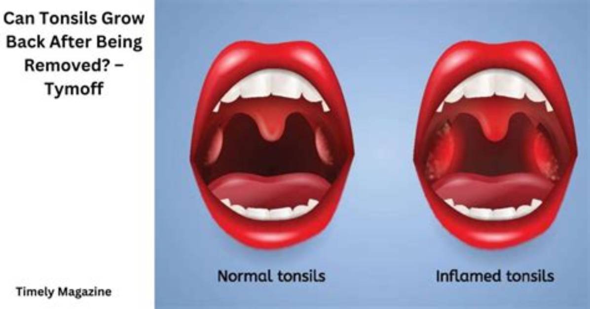 Could Tonsils Grow Back?