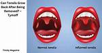 Could Tonsils Grow Back?