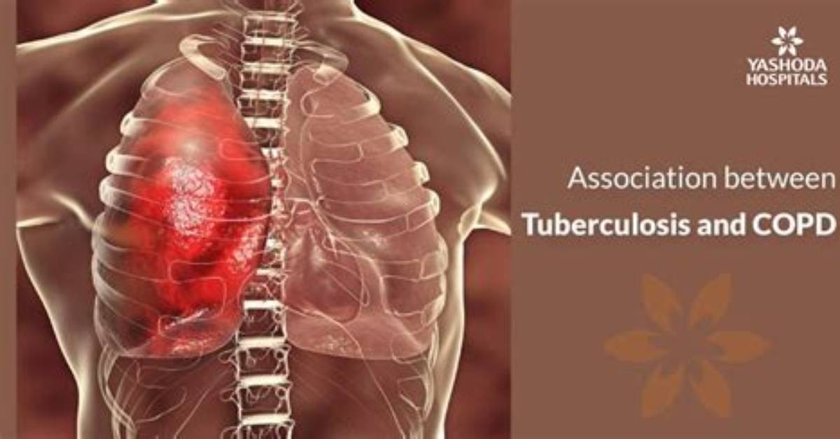 Could Tuberculosis Cause Copd?
