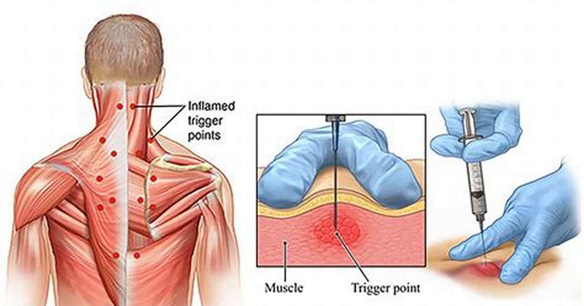 Cpt Trigger Point Injection